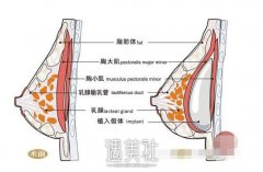 法国es假体隆胸机构贵吗?各地收费差距大吗? width=
