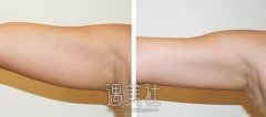 深圳360度吸脂减肥价格大概多少?什么价位合理? width=