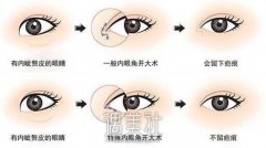 做开眼角塑型术花费大概多少?各大城市标准一样吗? width=