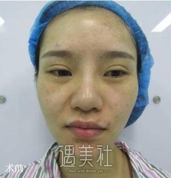 人造酒窝,前后对比照,真实案例分享