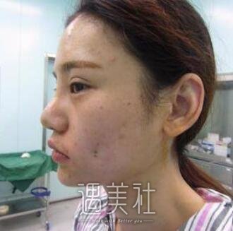 人造酒窝,前后对比照,真实案例分享