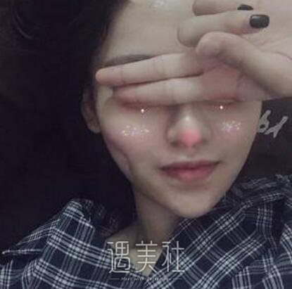 人造酒窝,前后对比照,真实案例分享