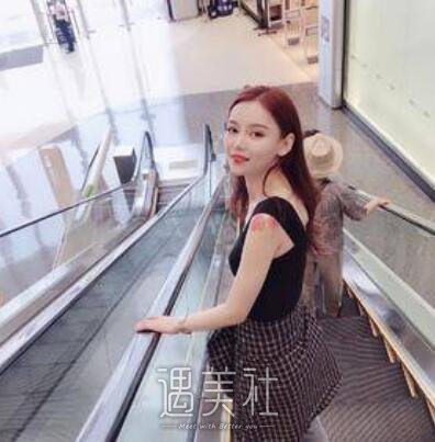 人造酒窝,前后对比照,真实案例分享