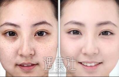 北京,复合彩光祛斑,价格一般多少