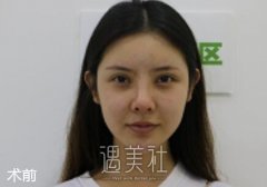 开内眼角前后对比图片|开内眼角案例分享~ width=