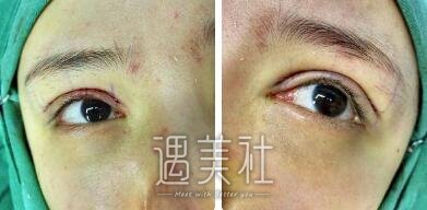 开内眼角,前后对比图片,案例分享