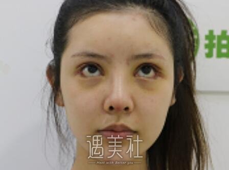 开内眼角,前后对比图片,案例分享