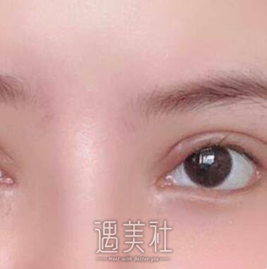 开内眼角,前后对比图片,案例分享