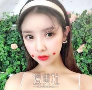 开内眼角,前后对比图片,案例分享