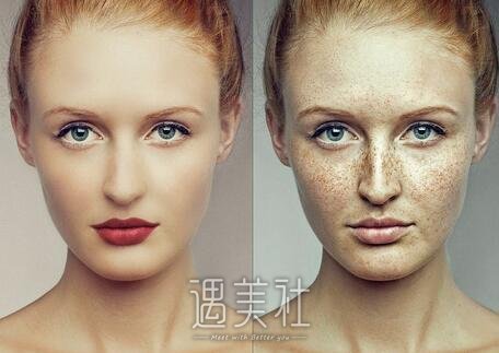 黄褐斑形成的原因及冶疗方法大盘点，快来围观!