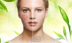 南昌彩光祛痘需要多少钱?去个痘应该不贵吧? width=