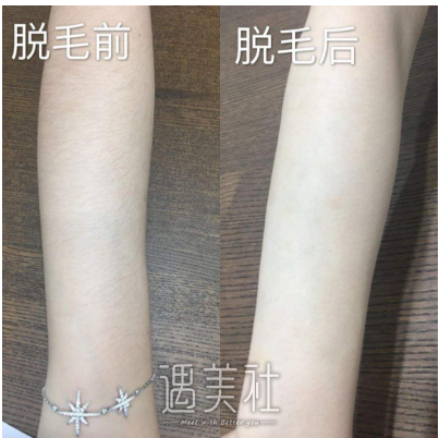 手臂激光脱毛多少钱一次?没必要纠结公立私立的选择吧?