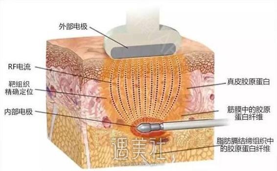 像束激光除皱是什么?像束激光除皱多方面了解下~