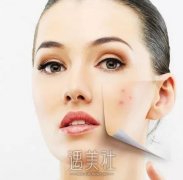 像素激光去痘疤一般要做几次才有比较明X的果喃? width=