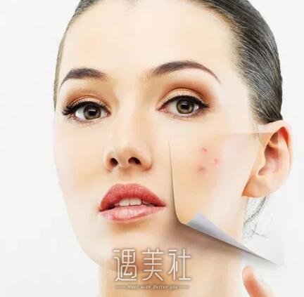 像素激光去痘疤