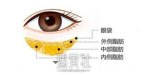 抽脂去眼袋费用