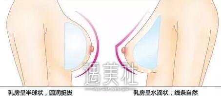 蜜桃假体隆胸