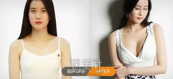 蜜桃假体隆胸