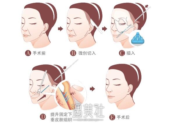 筋膜悬吊除皱