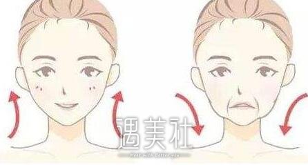 筋膜悬吊除皱