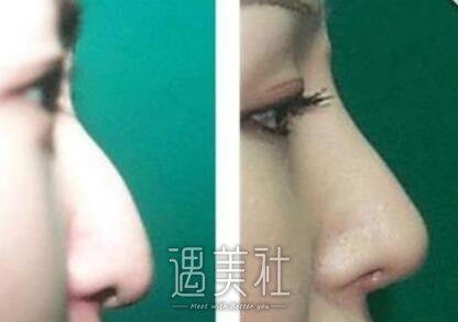 驼峰鼻矫正,方法有哪些,哪种果更好