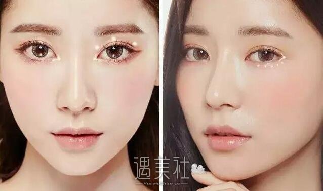 北京双眼皮多少钱?会比欧式双眼皮贵吗?