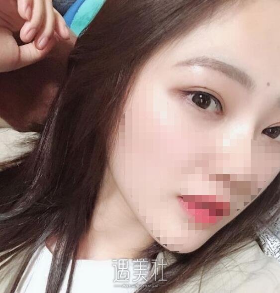 广州曙光王娟做双眼皮怎么样?真实案例分享~