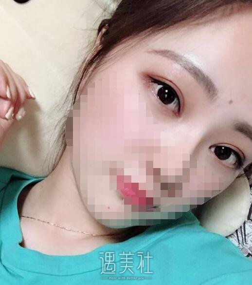 广州曙光王娟做双眼皮怎么样?真实案例分享~