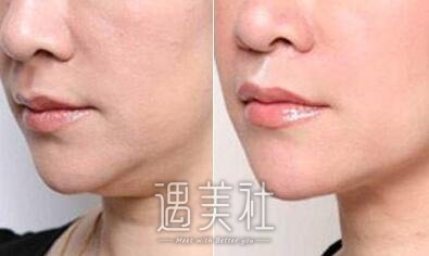 360溶脂减肥是什么原理?没问题性应该有保障吧?