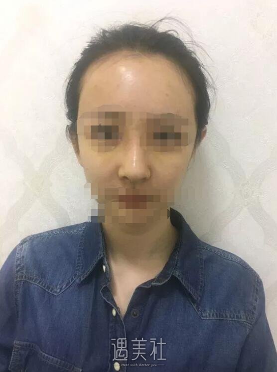 巫文云隆鼻修复技术好吗|巫文云隆鼻修复案例一览~