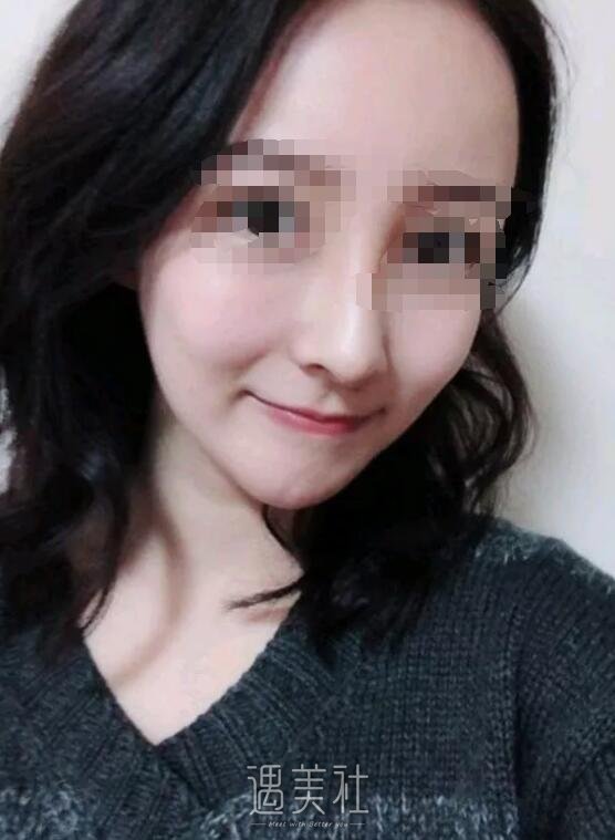 巫文云隆鼻修复技术好吗|巫文云隆鼻修复案例一览~