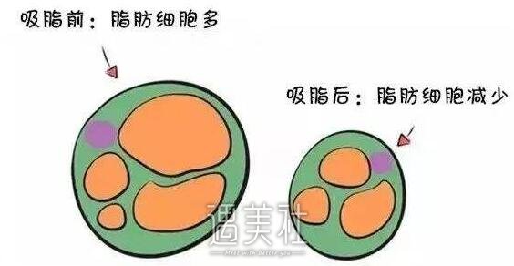 韩式共振吸脂减肥