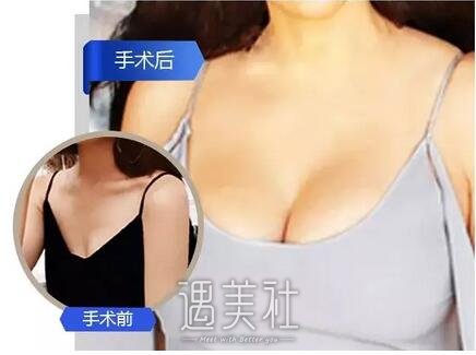 es假体隆胸