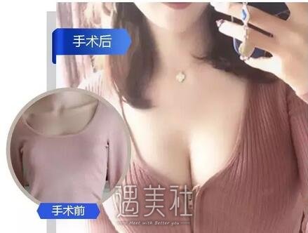 es假体隆胸