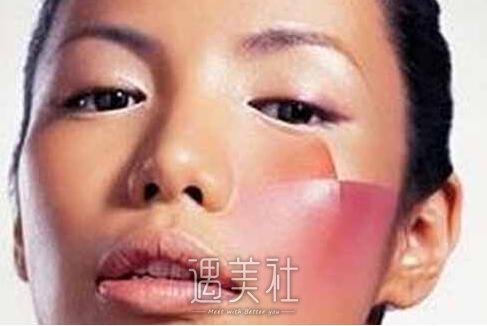 复合彩光,调节红血丝,果好吗,有哪些优势