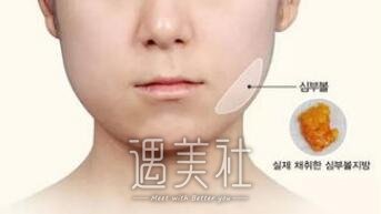 面部吸脂,去颊脂垫,哪个好,优缺点
