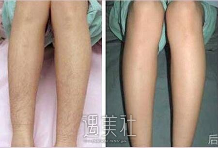 绝缘微针脱毛,有用吗,为何不被提倡