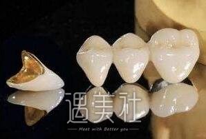连云港做普通烤瓷牙价格大概多少钱?贵不贵呢?