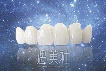 连云港做普通烤瓷牙价格大概多少钱?贵不贵呢?