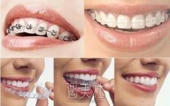 厦门矫正牙齿的价格大概多少呢?二爷又来问我了! width=
