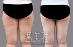 天津大腿部抽脂多少钱呢?单部位收费情况是怎样的呢? width=