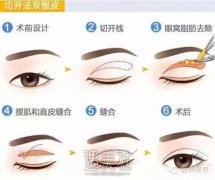 丹东全切双眼皮多少钱?能和一二线城市收费比吗? width=
