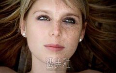 激光祛斑会反弹吗？怎么减小反弹的可能性喃？ width=