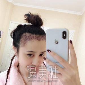 种发际线果图