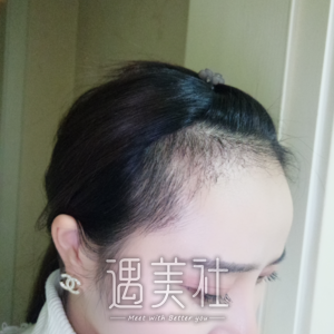 种发际线果图