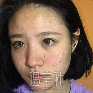果酸换肤