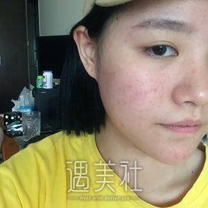 果酸换肤