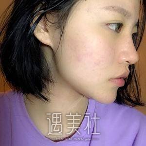 果酸换肤