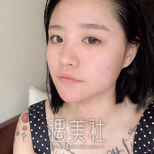 果酸换肤