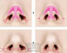 鼻翼改薄整形医院做好还是公办医院好?在线等! width=